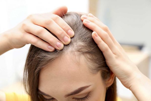 Alopecia, una secuela del COVID-19, dice la UNAM.