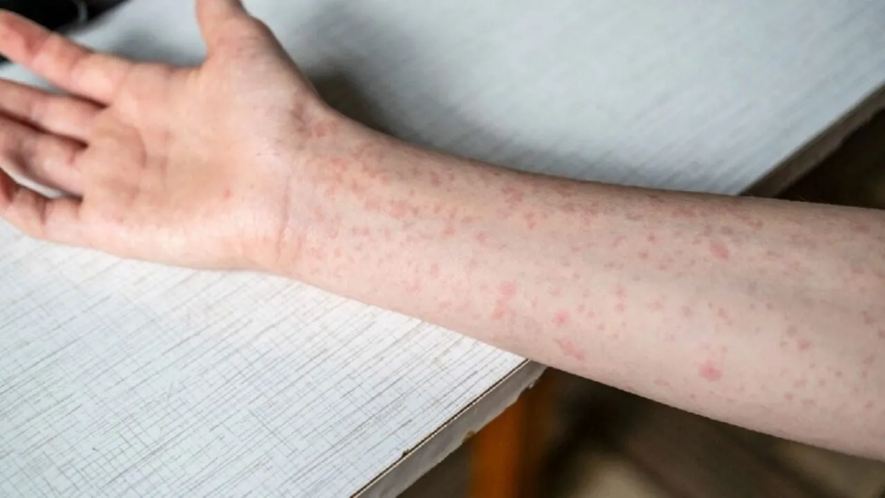 Confirman 13 casos importados de sarampión en Morelos