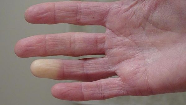 Enfermedad de Raynaud, ¿congelación o mala circulación? 