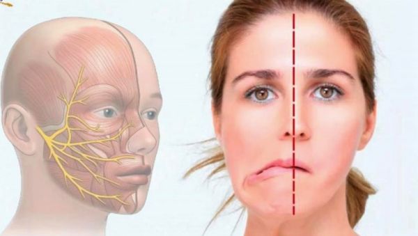 Cosas que detonan parálisis facial…además del estrés 